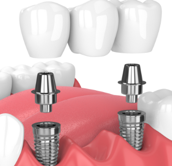 安钛科基台及附件
