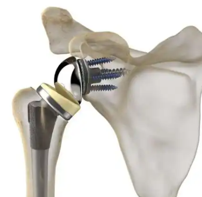 锐适肩关节假体系统