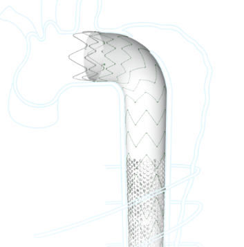 库克胸主动脉覆膜支架系统
