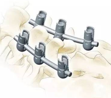 脊柱绑带内固定系统LIGAPASS